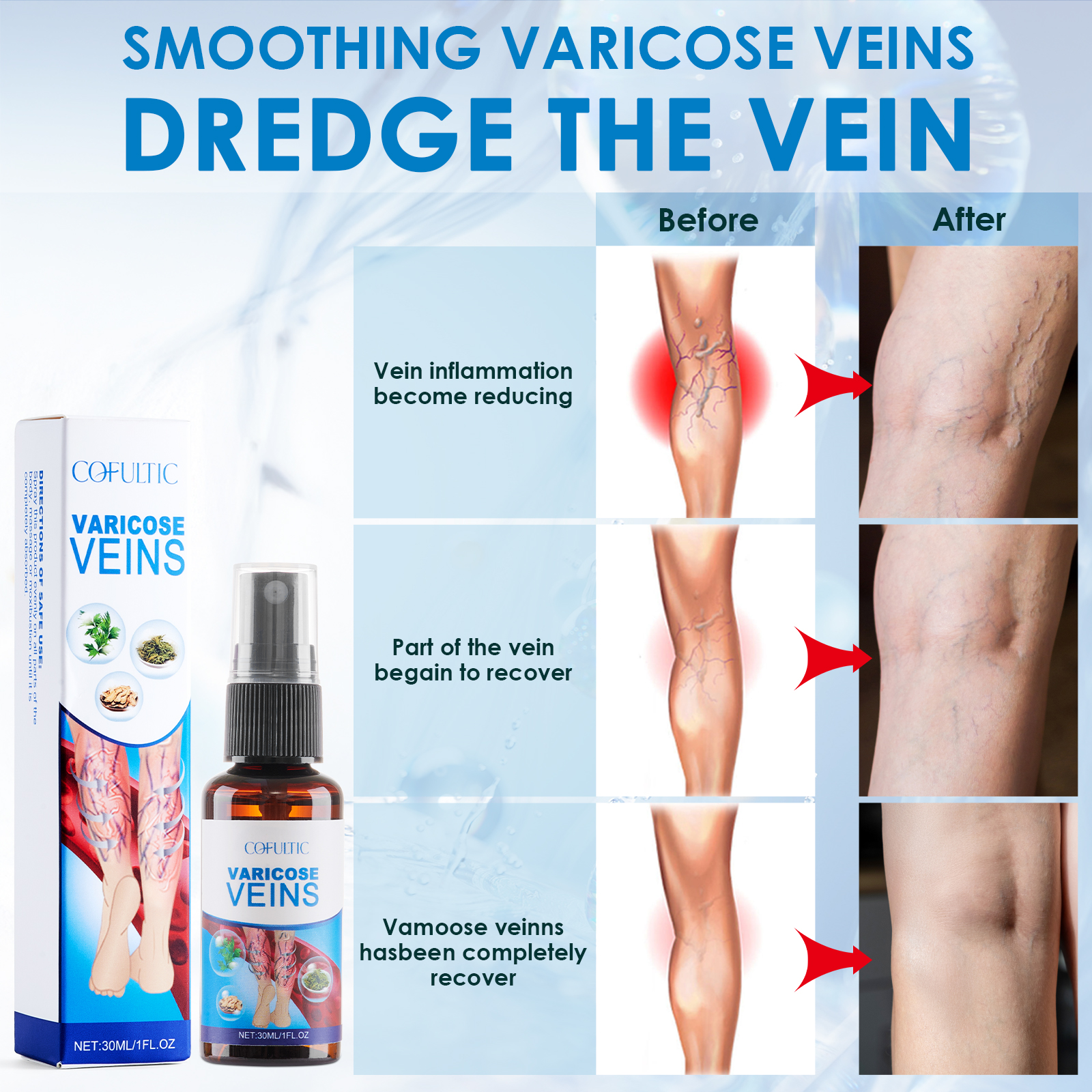 30ml Varicose Vein Spray Multi-Purpose Knee And Leg Care Spray Promote Blood Circulation