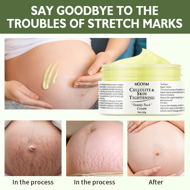 Stretch Mark Cream Fat Body Pattern Recovery Cream